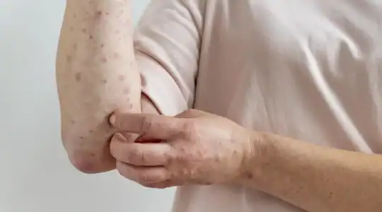Allergies liées aux punaises de lit : symptômes et traitements 1 allergie aux piqures de punaises de lit
